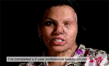 Don’t cringe on seeing our faces: Acid attack survivors share video CVs